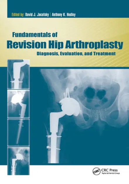 Crafted Fundamentals of Revision Hip Arthroplasty: Diagnosis, Evaluation, and Treatment