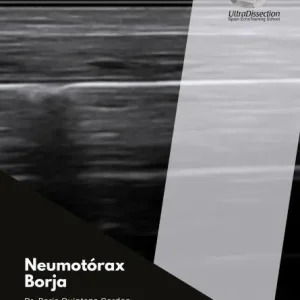 Diagnóstico del neumotórax por ecografía Order Now