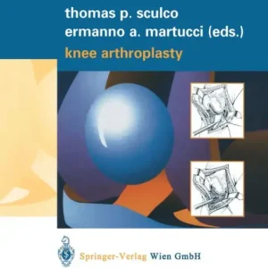 Knee Arthroplasty New Arrival
